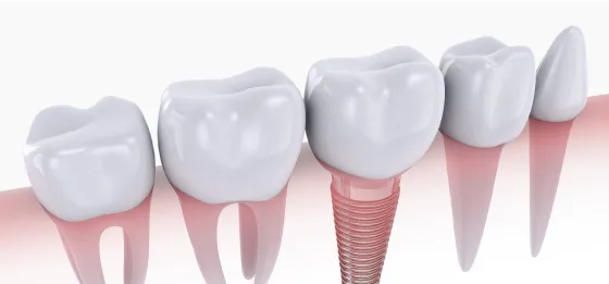 tooth crown on the implant 3d model
