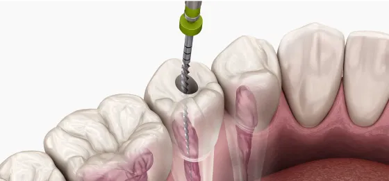 endodontic treeeatment 3d model