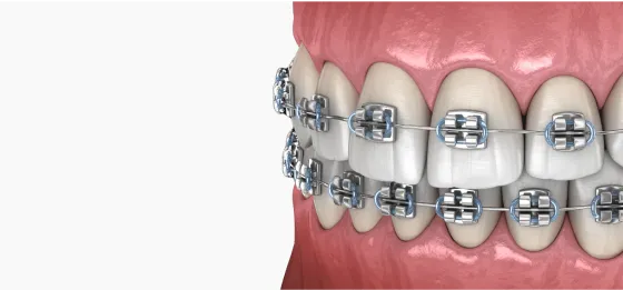 braces 3d model
