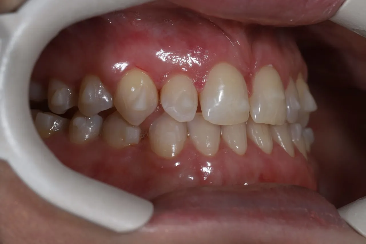 після елайнерів