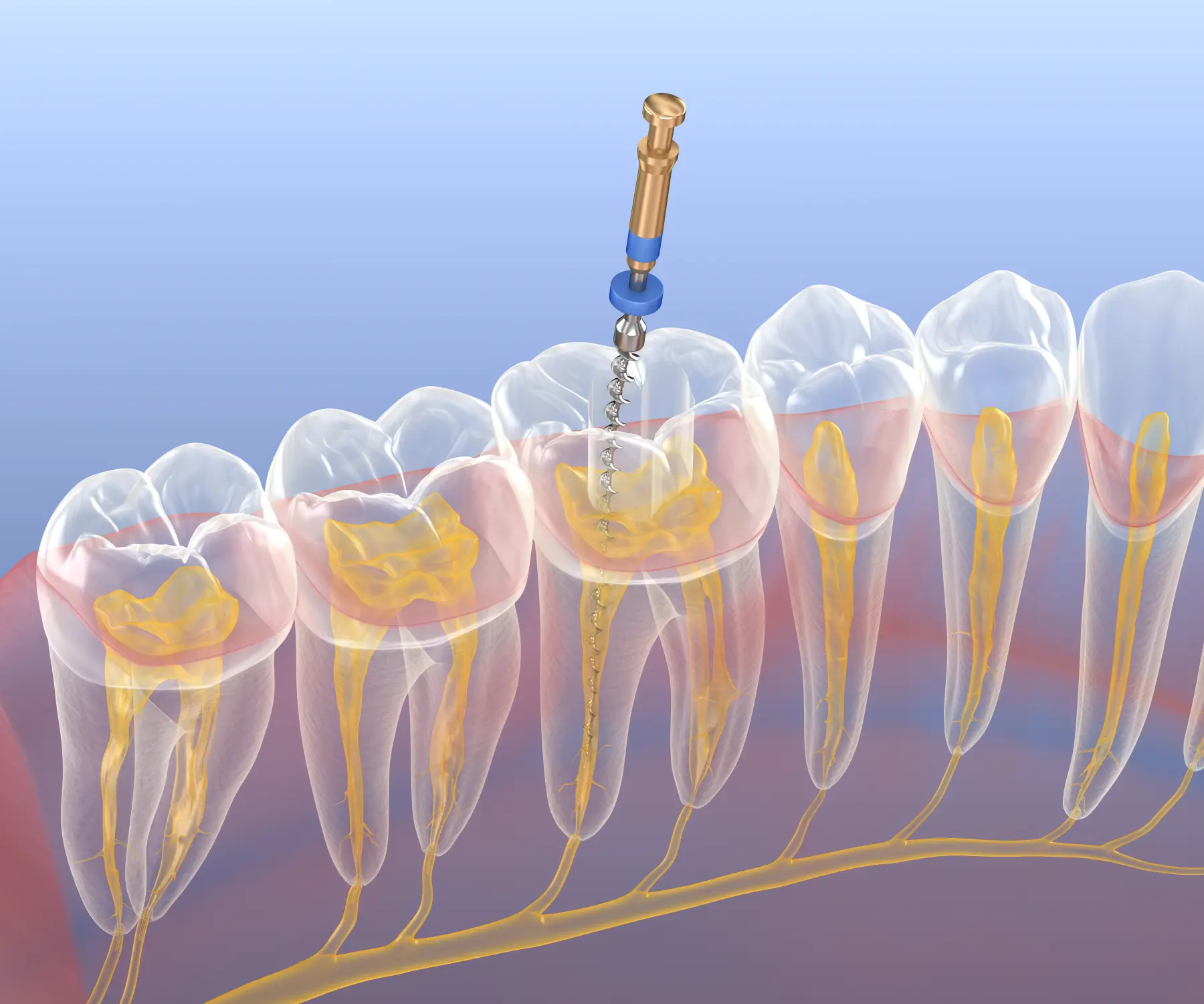 Root Canal Therapy in Bethlehem: Fast, Effective, and Painless Relief
