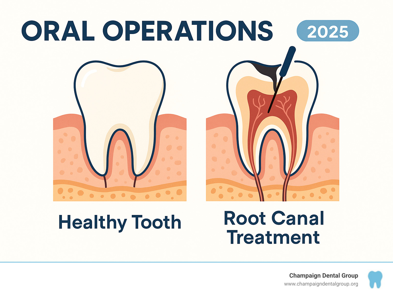 Diagram showing a healthy tooth next to one needing a root canal treatment.