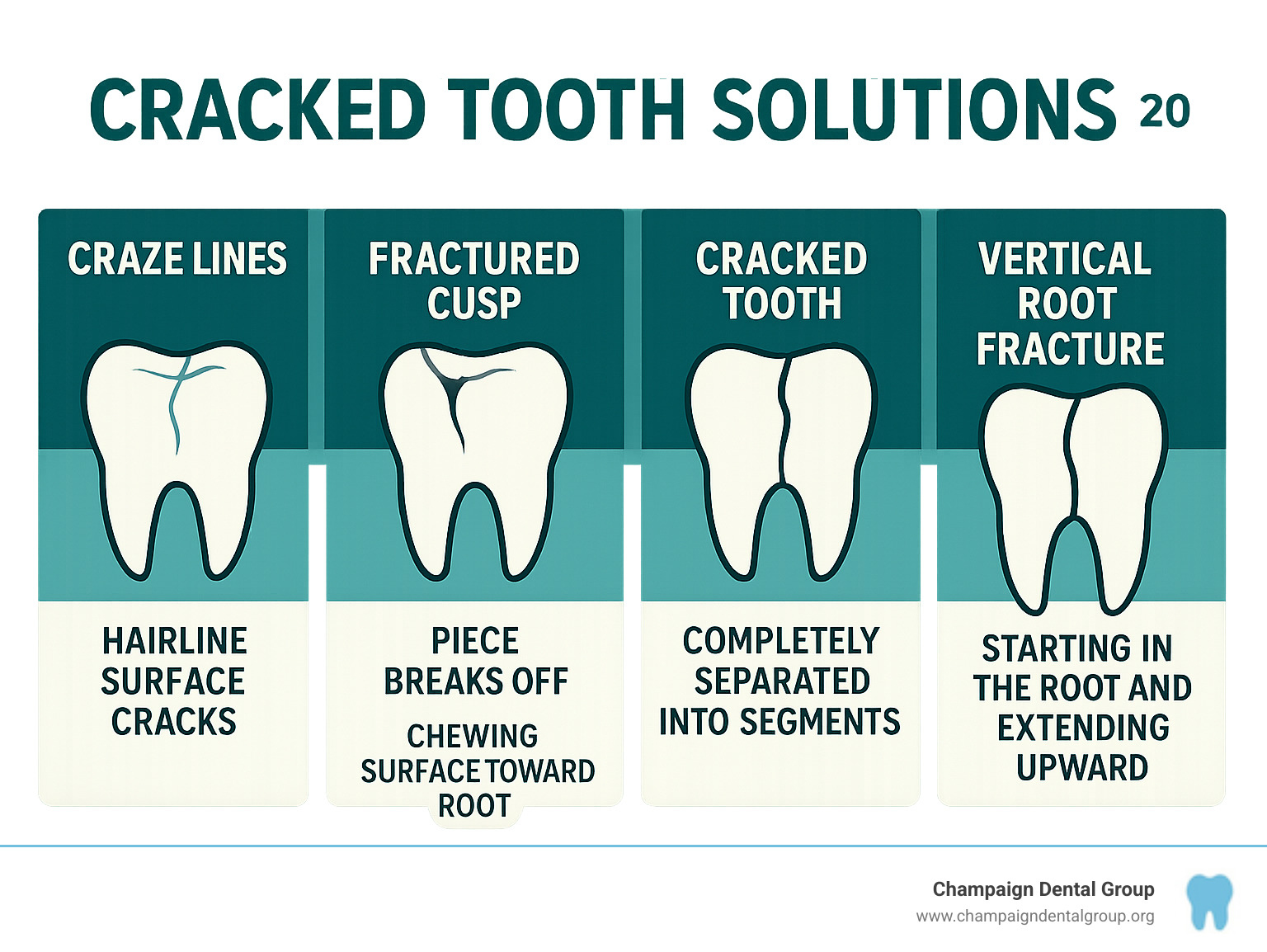 Infographic showing the five main types of tooth cracks: craze lines as hairline surface cracks, fractured cusp where a piece breaks off, cracked tooth extending from chewing surface toward root, split tooth completely separated into segments, and vertical root fracture starting in the root and extending upward - Cracked tooth solutions infographic 
