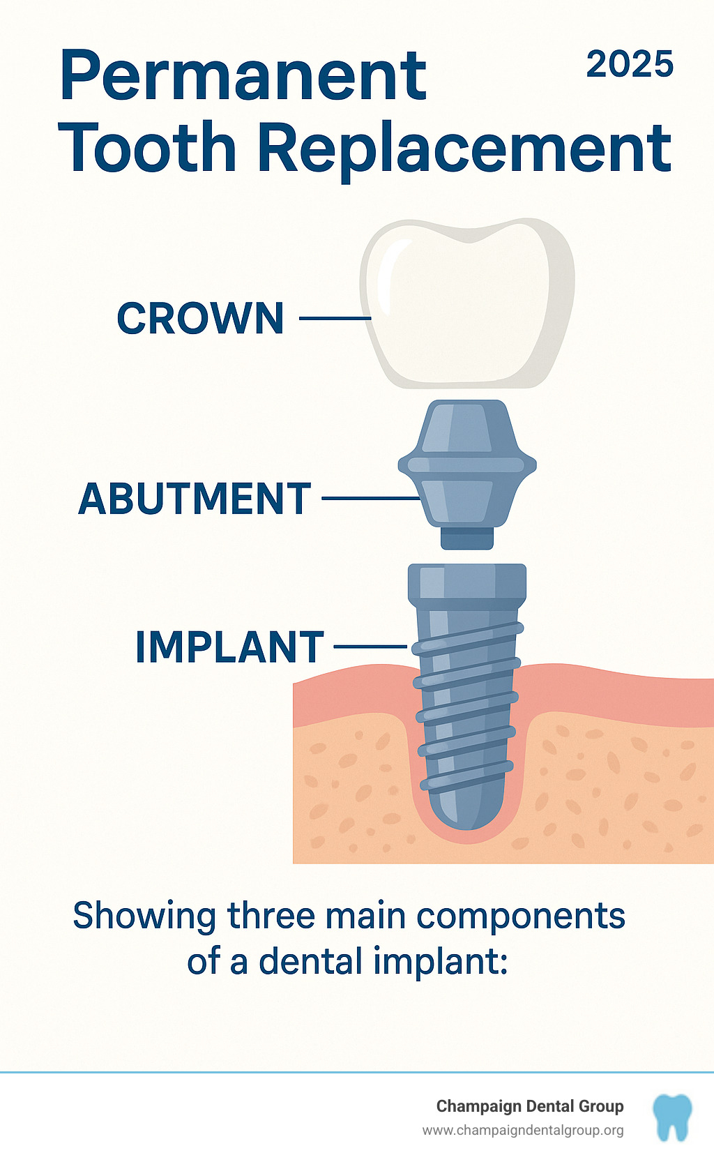 Infographic showing the three main components of a dental implant: the titanium implant post that goes into the jawbone, the abutment connector piece, and the crown that looks like a natural tooth - Permanent tooth replacement infographic 