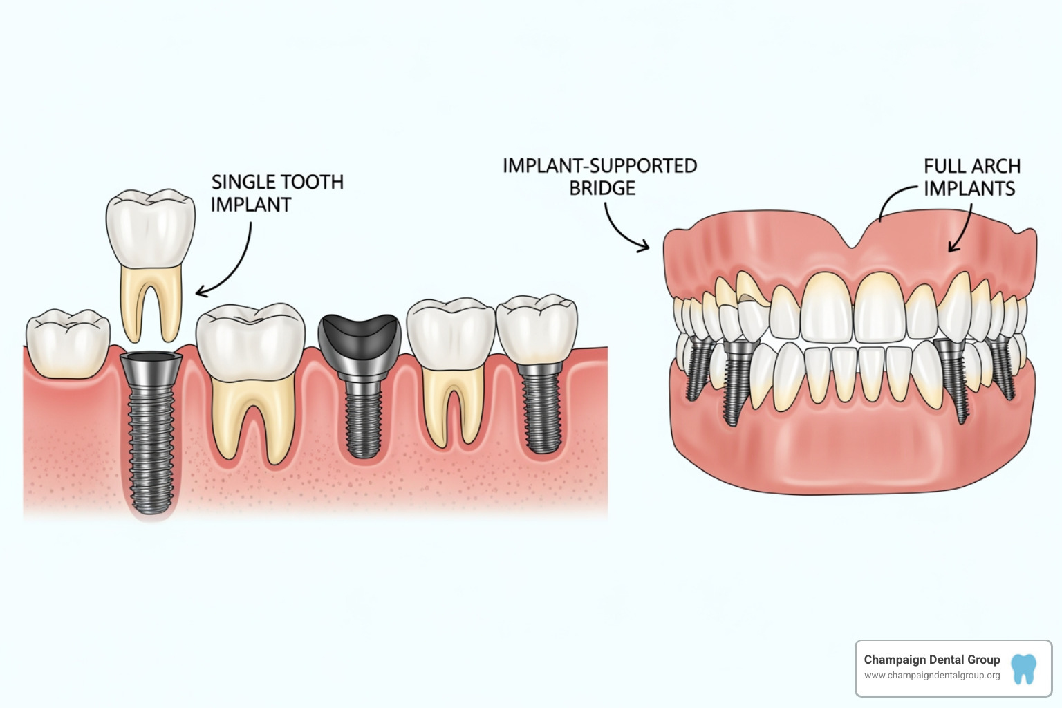 illustrating different types of dental implant solutions like a single tooth, an implant-supported bridge, and a full arch - does insurance pay for dental implants