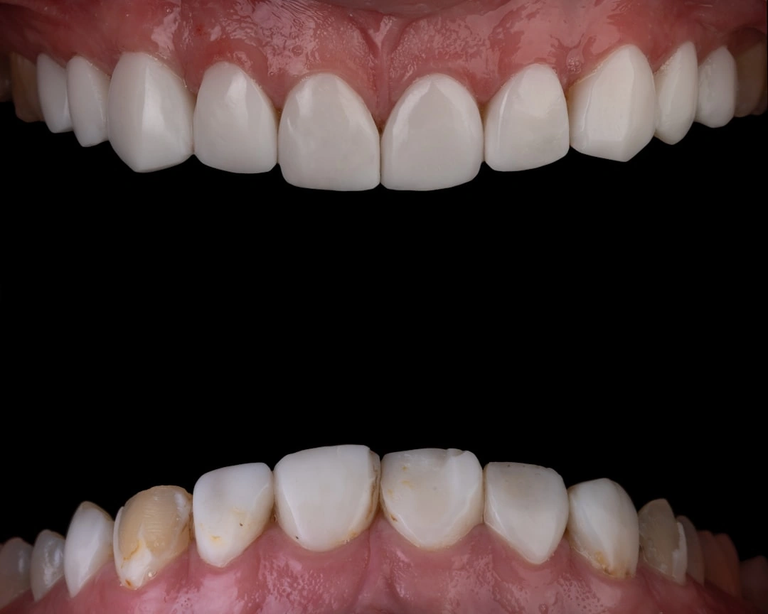 cosmetic bonding teeth before and after