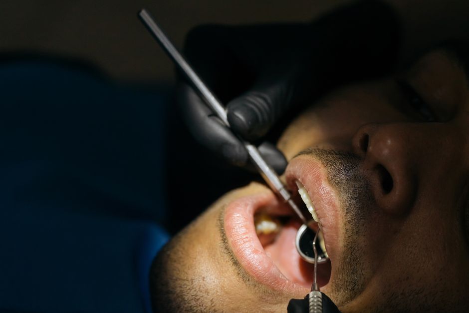 black tartar on teeth near gumline