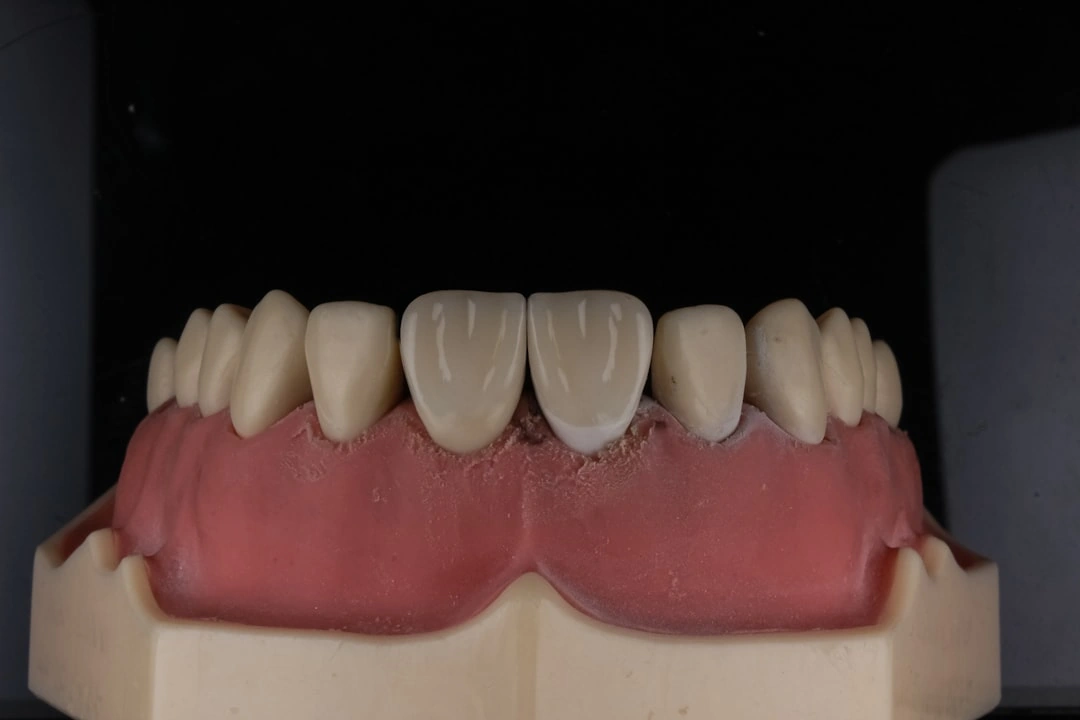 dental bridge types
