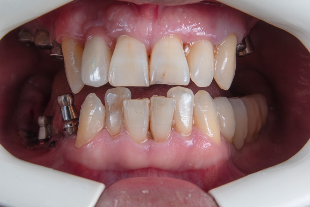 all in 4 dental implants