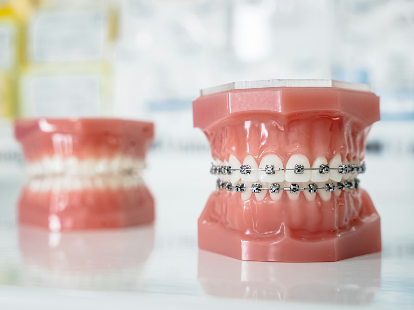 Dental models showing teeth with and without braces