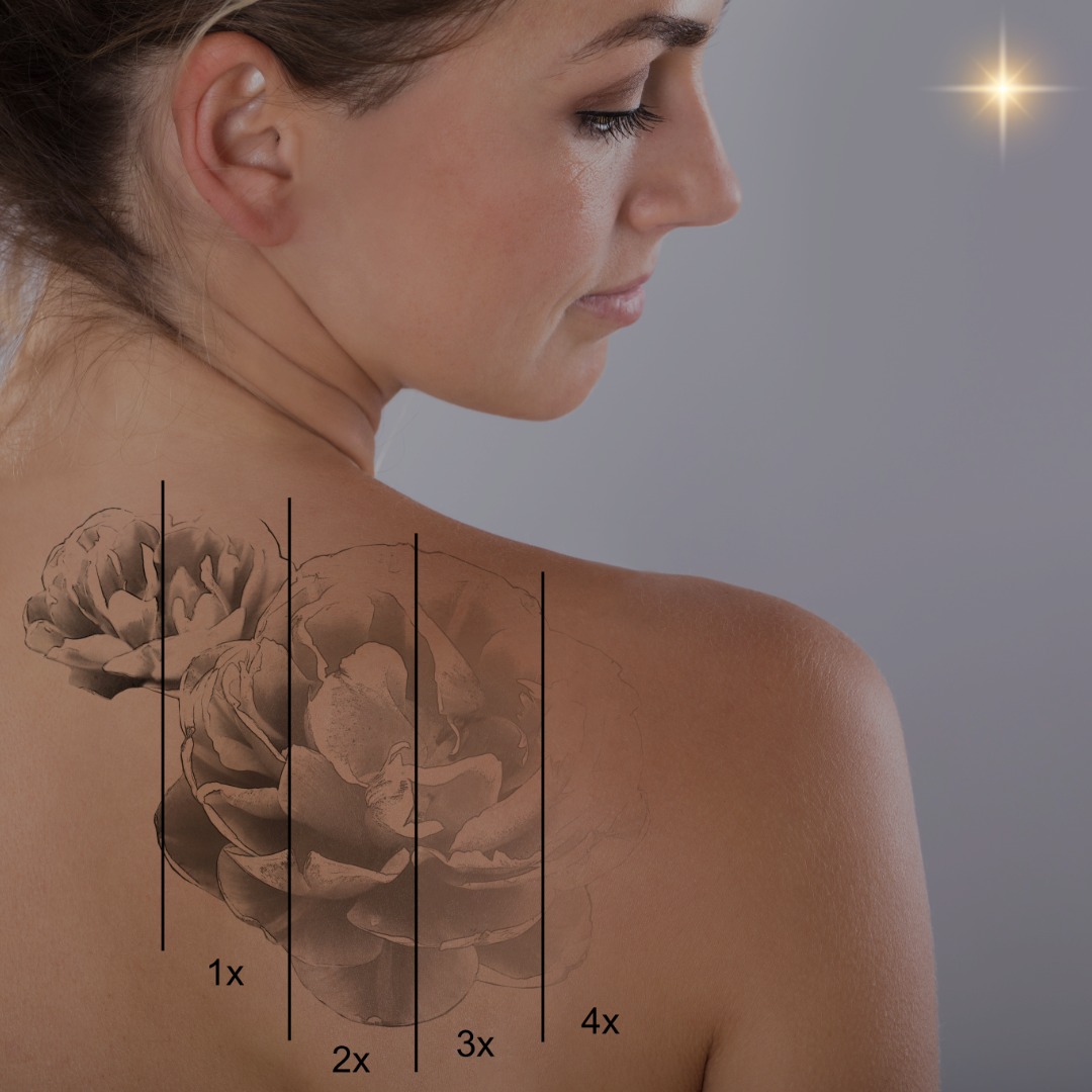 tattoo removal