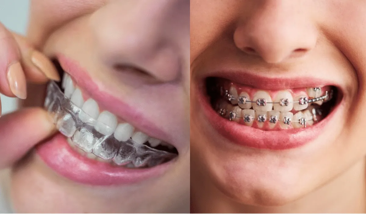 Are Clear Aligners Really Better Than Traditional Braces?