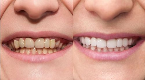 What Causes Tooth Staining (and How to Prevent It)