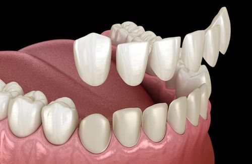 What You Need to Know Before Getting Veneers