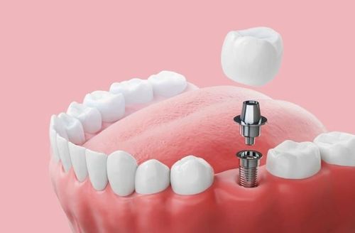 What to Expect From a Dental Implant Procedure
