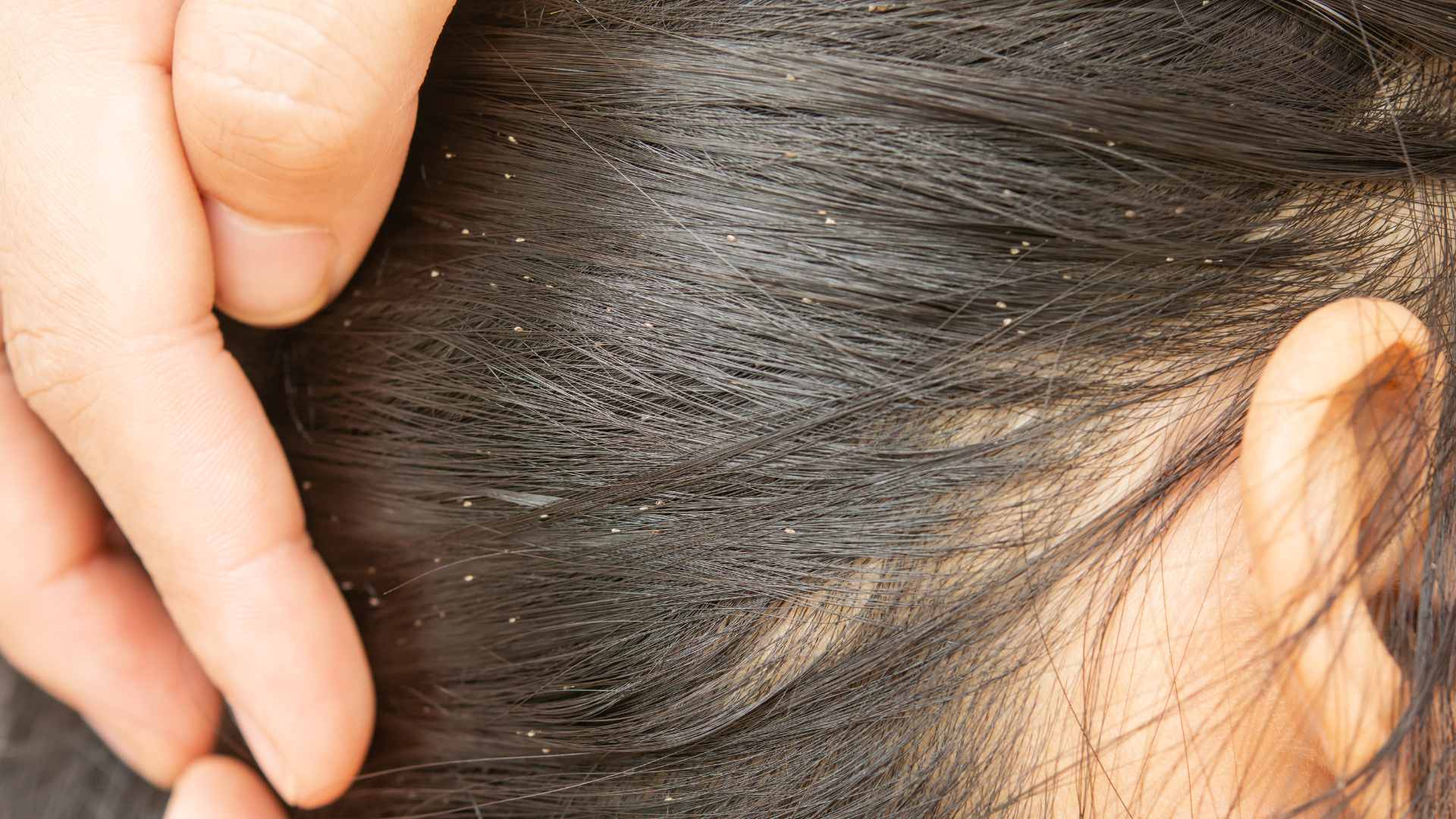 What Exactly Are Head Lice?