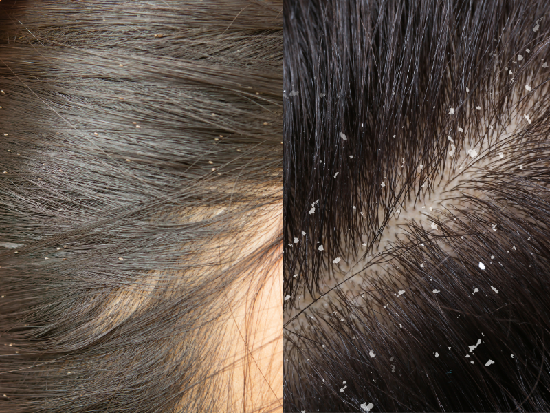 Is It Dry Scalp or Lice? Solving the Late-Winter Itch