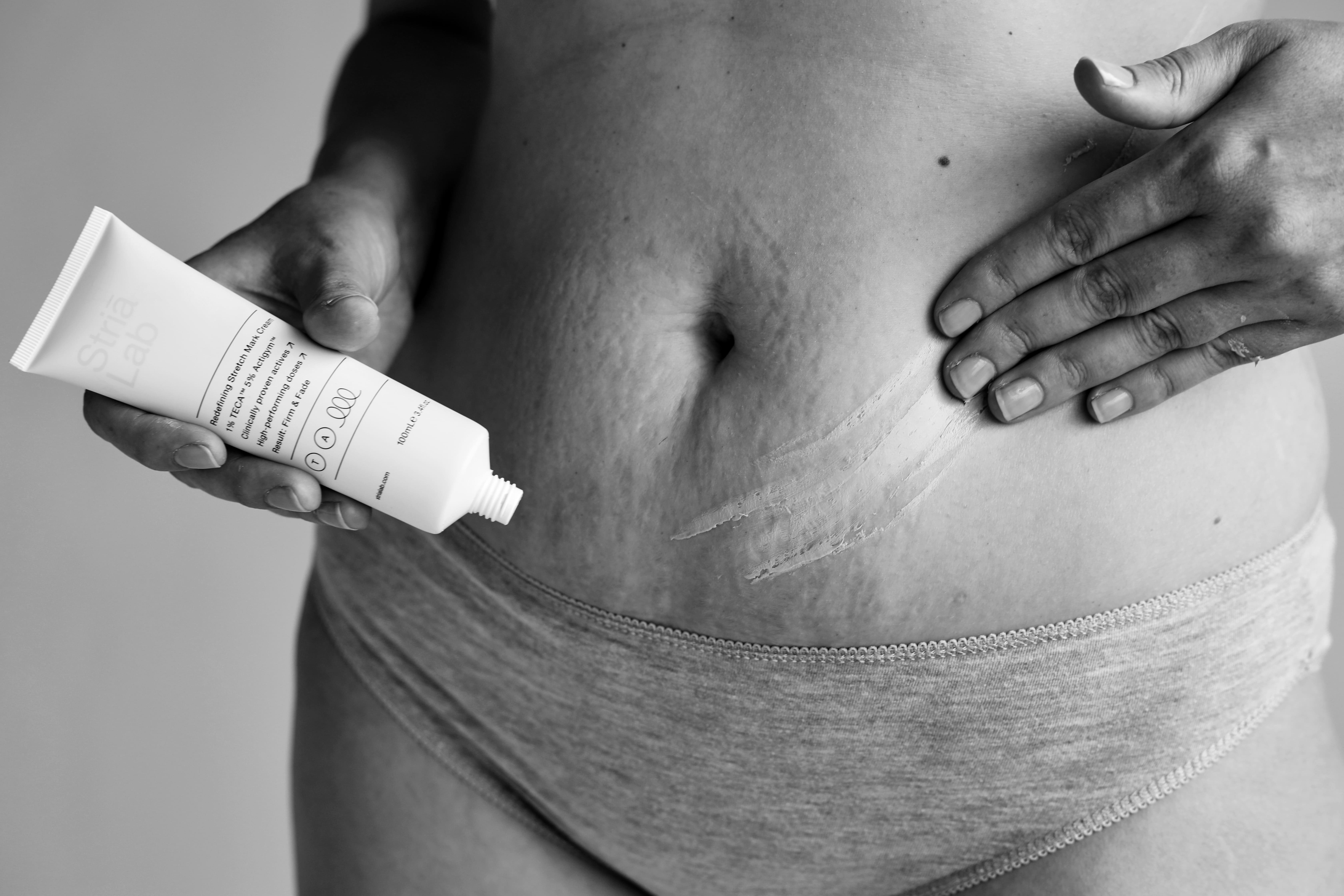 Meet Striā Lab: Finally, a clinically proven solution for stretch marks