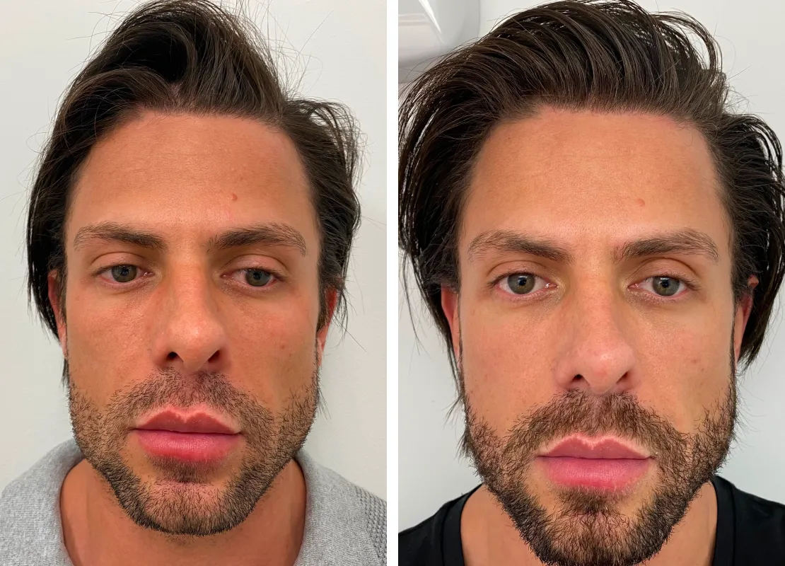 Before and after comparison following profhilo treatment
