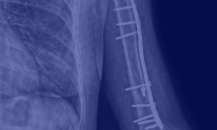 Рентген після остеосинтезу у клініці Mashtaler Ortho&Trauma. Металева пластина стабілізує кістку, забезпечуючи точне зрощення та швидке відновлення функції руки.
