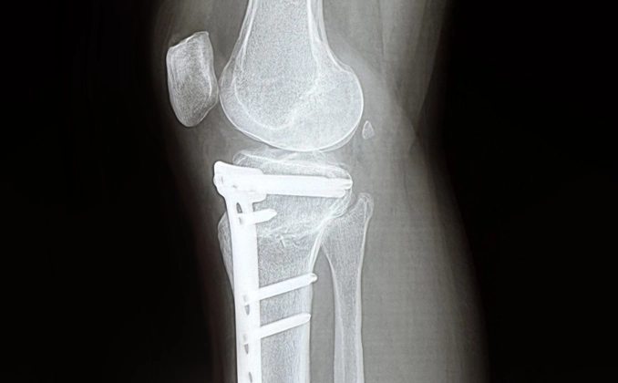 Рентгенівський знімок колінного суглоба з фіксаційною пластиною після остеотомії великогомілкової кістки