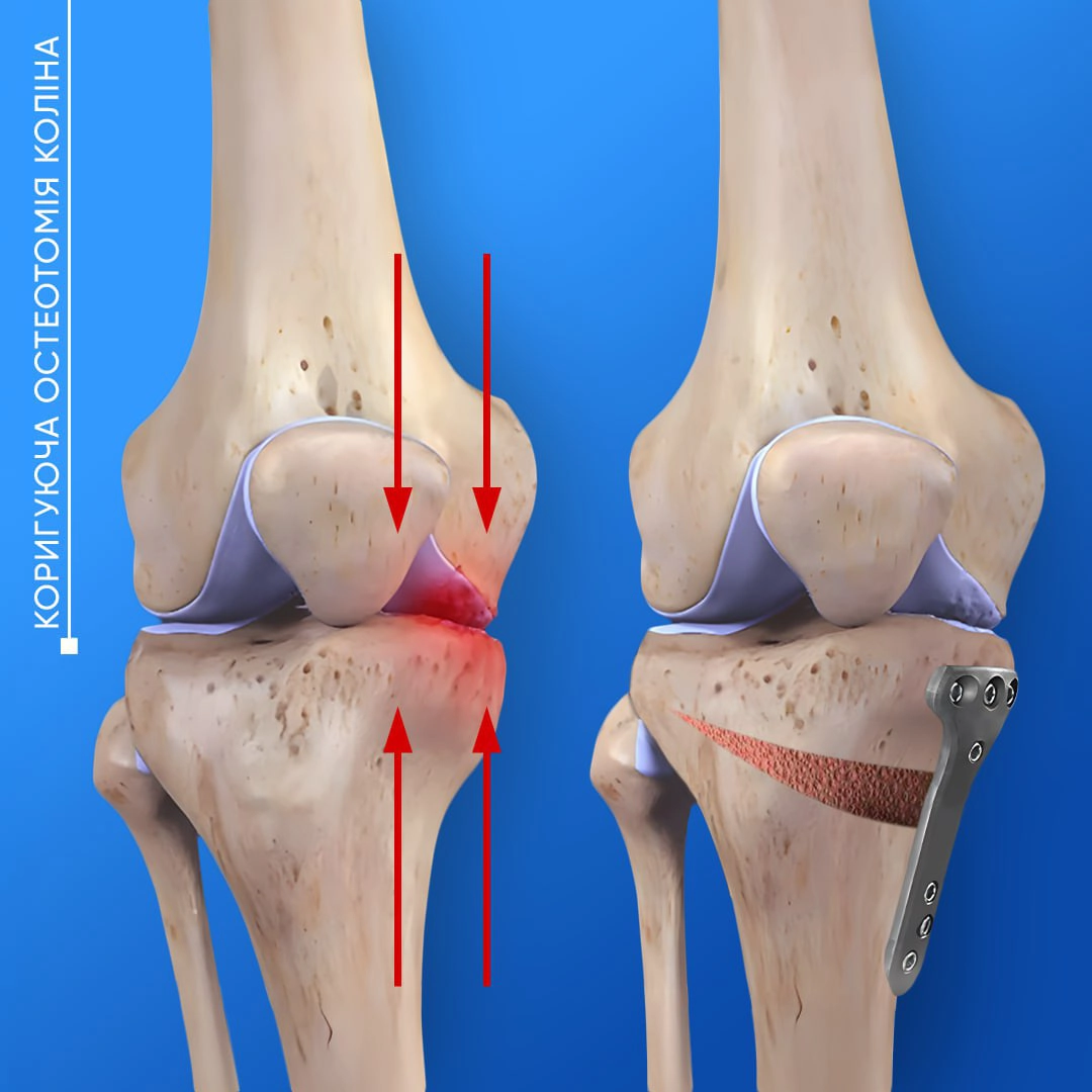 Схема коригуючої остеотомії коліна з вирівнюванням осі та фіксацією пластиною.