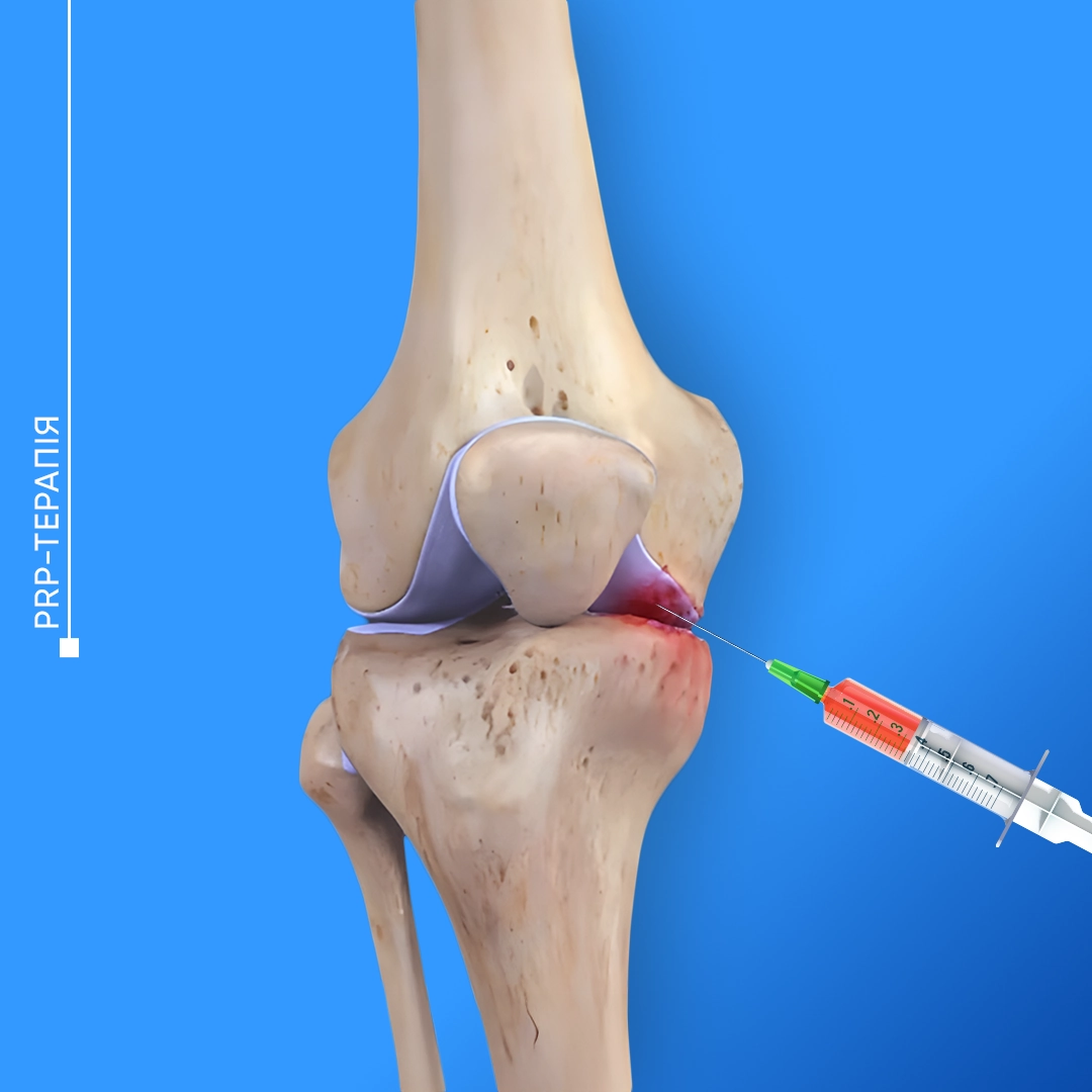 Введення PRP-плазми у колінний суглоб для лікування артрозу та запалення.