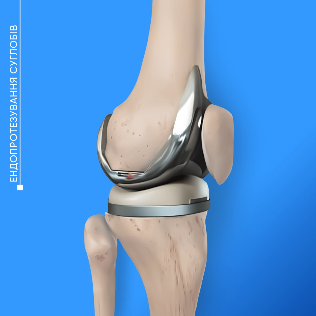 Схема ендопротезування колінного суглоба з установленими металевими компонентами імпланта.