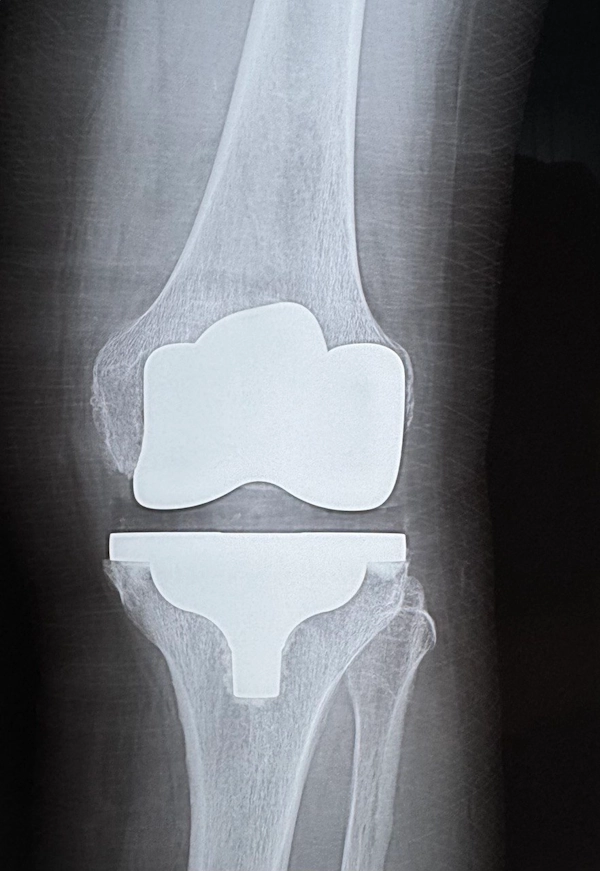Рентгенографія колінного суглоба після ендопротезування з установленим