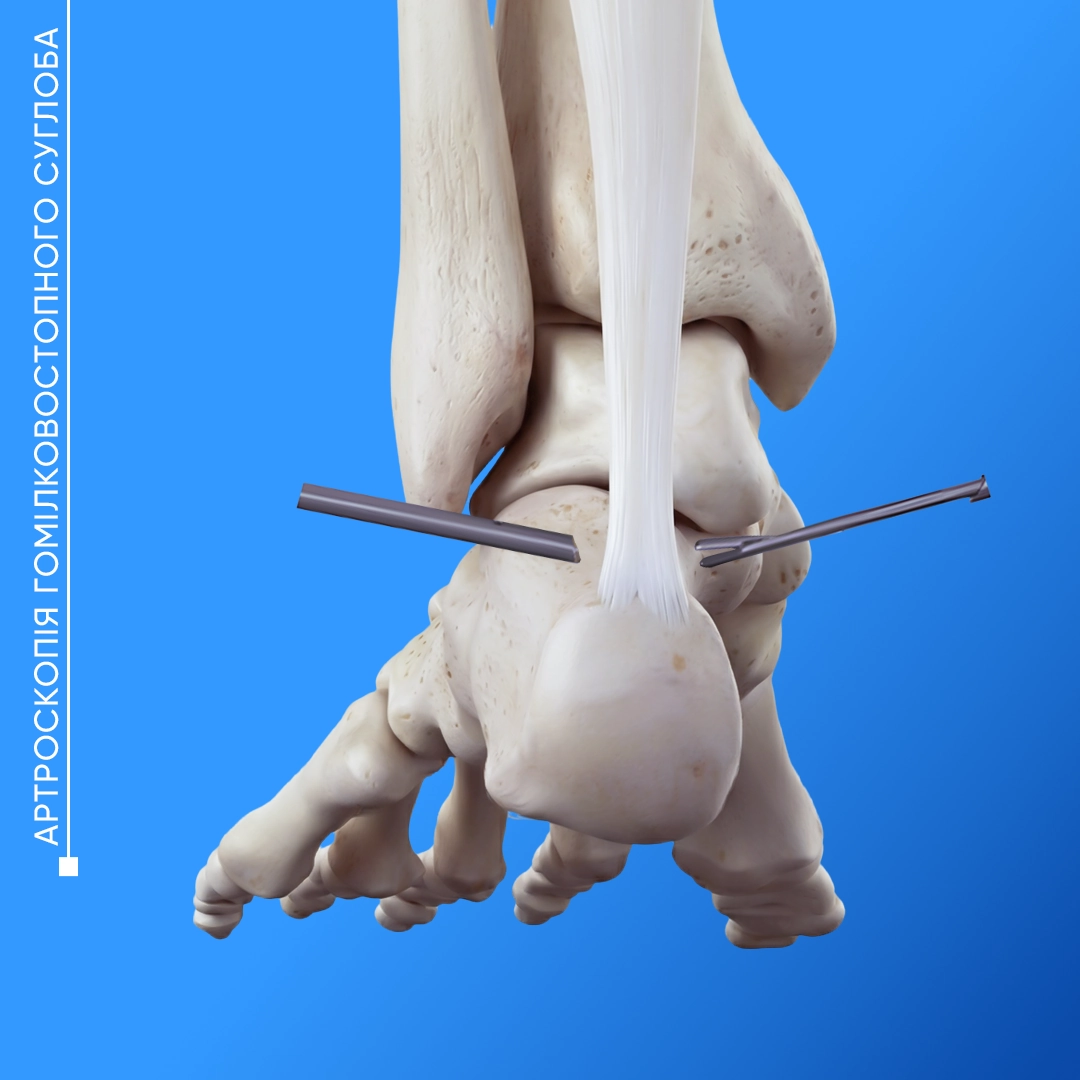 Артроскопія гомілковостопного суглоба у Львові для лікування травм, пошкодження зв’язок і хряща та відновлення рухливості.