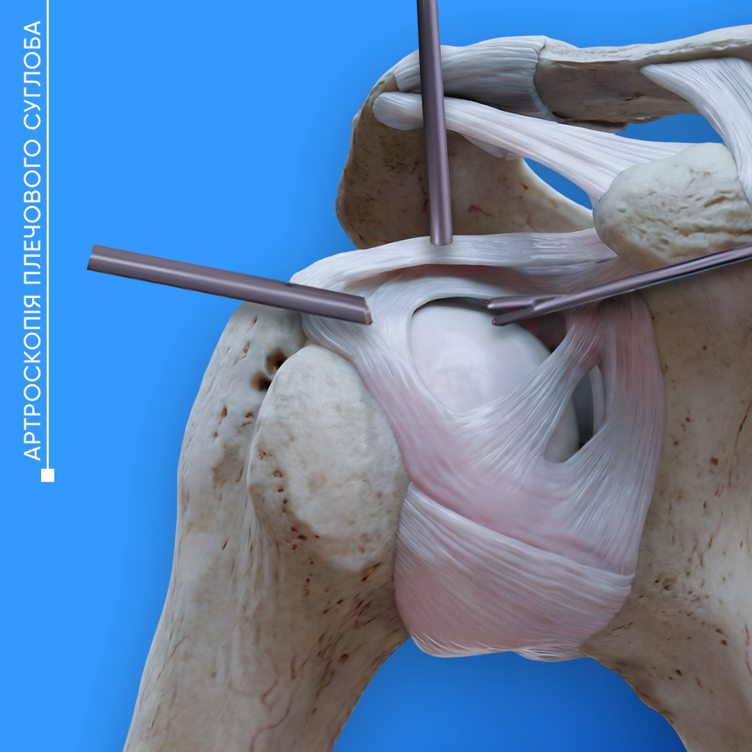 Артроскопія плечового суглоба у Львові для лікування травм, пошкодження зв’язок і відновлення рухливості плеча.