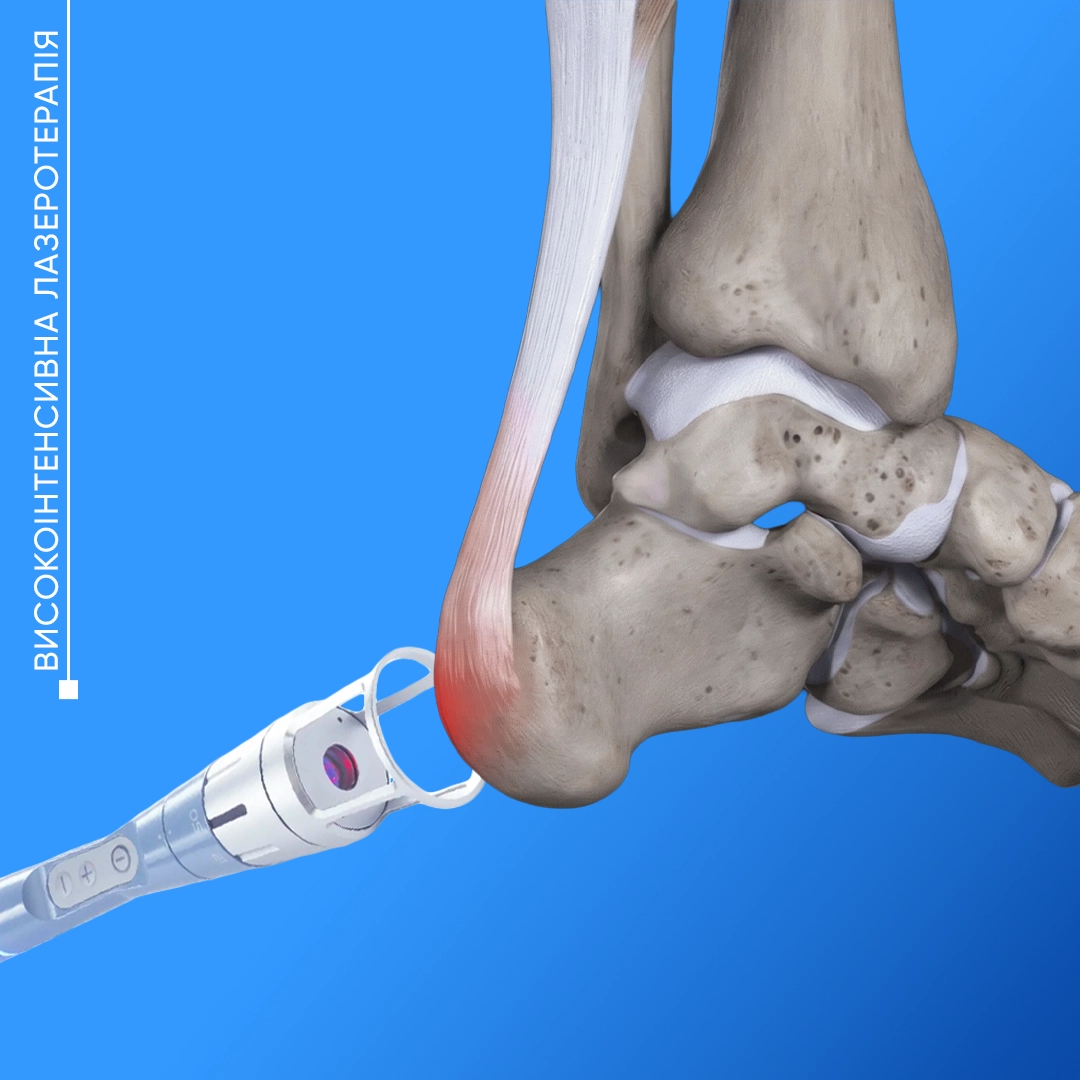 Високоінтенсивна лазеротерапія у Львові для лікування болю, травм сухожиль і суглобів та прискорення відновлення тканин.