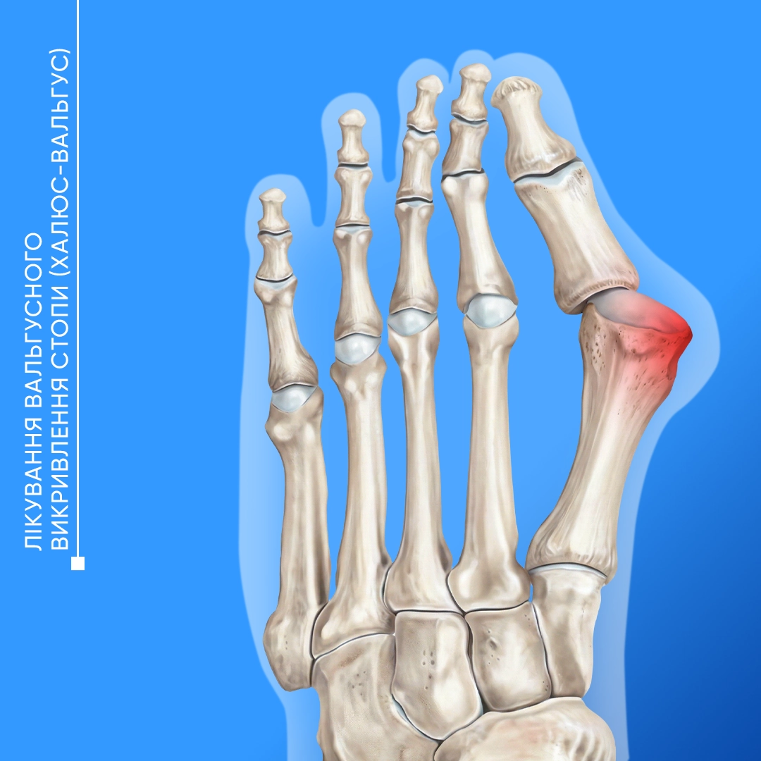 Лікування Hallux valgus у Львові. Сучасні методи корекції вальгусної деформації великого пальця стопи та усунення болю.