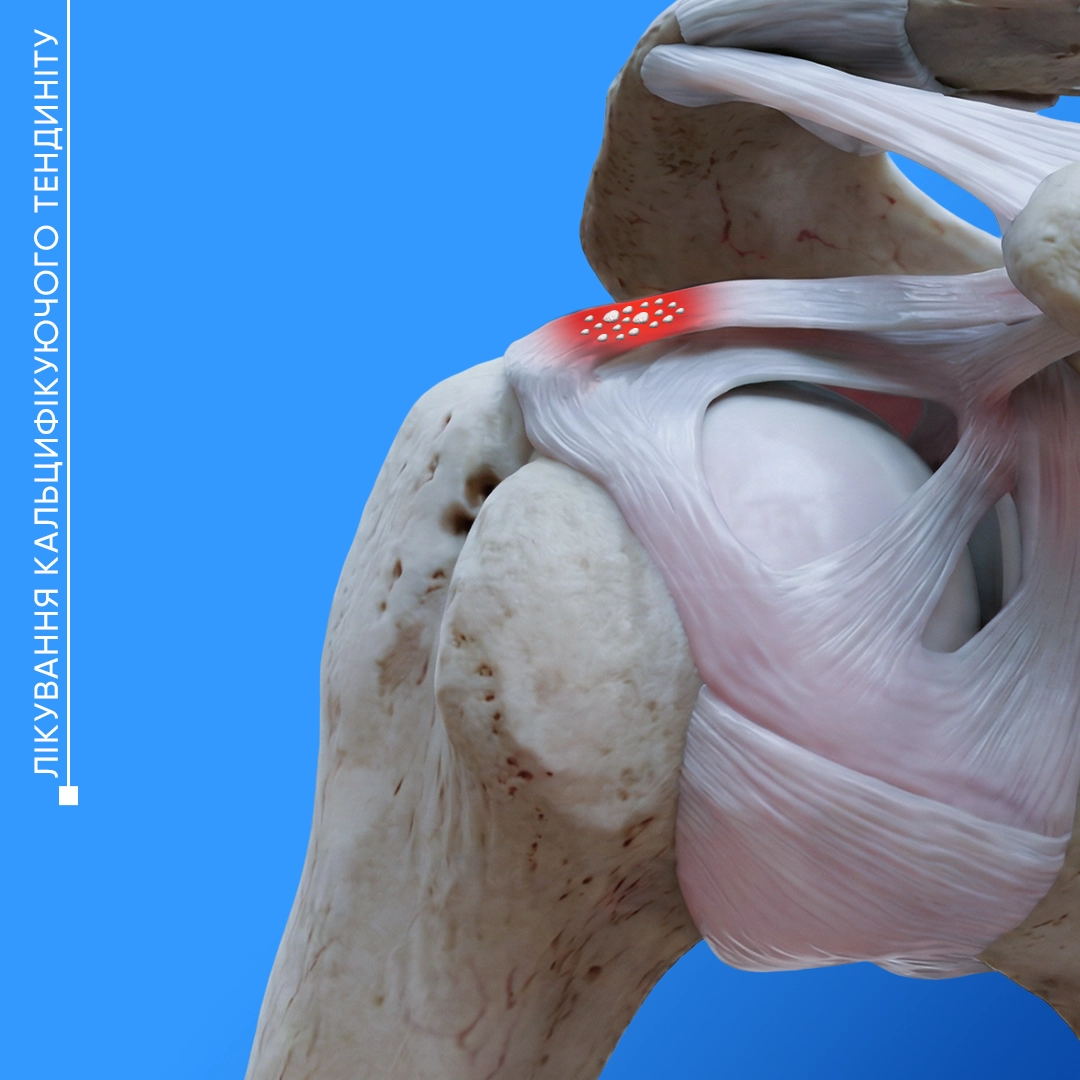 Лікування кальцифікуючого тендиніту у Львові. Усунення болю та відкладень кальцію в сухожиллях плечового суглоба сучасними методами.