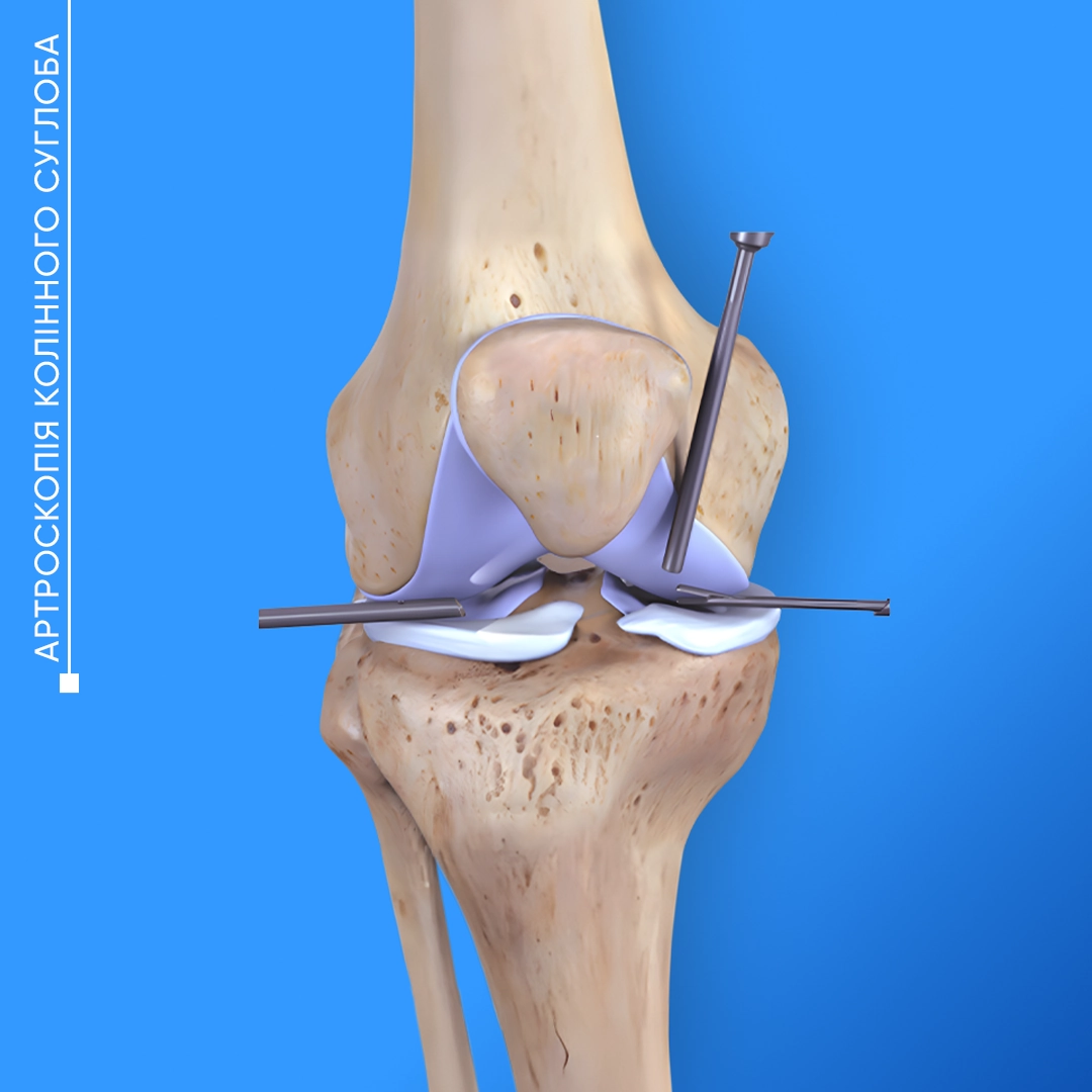 Артроскопія колінного суглоба у Львові для лікування травм меніска, зв’язок і хряща та відновлення рухливості коліна.