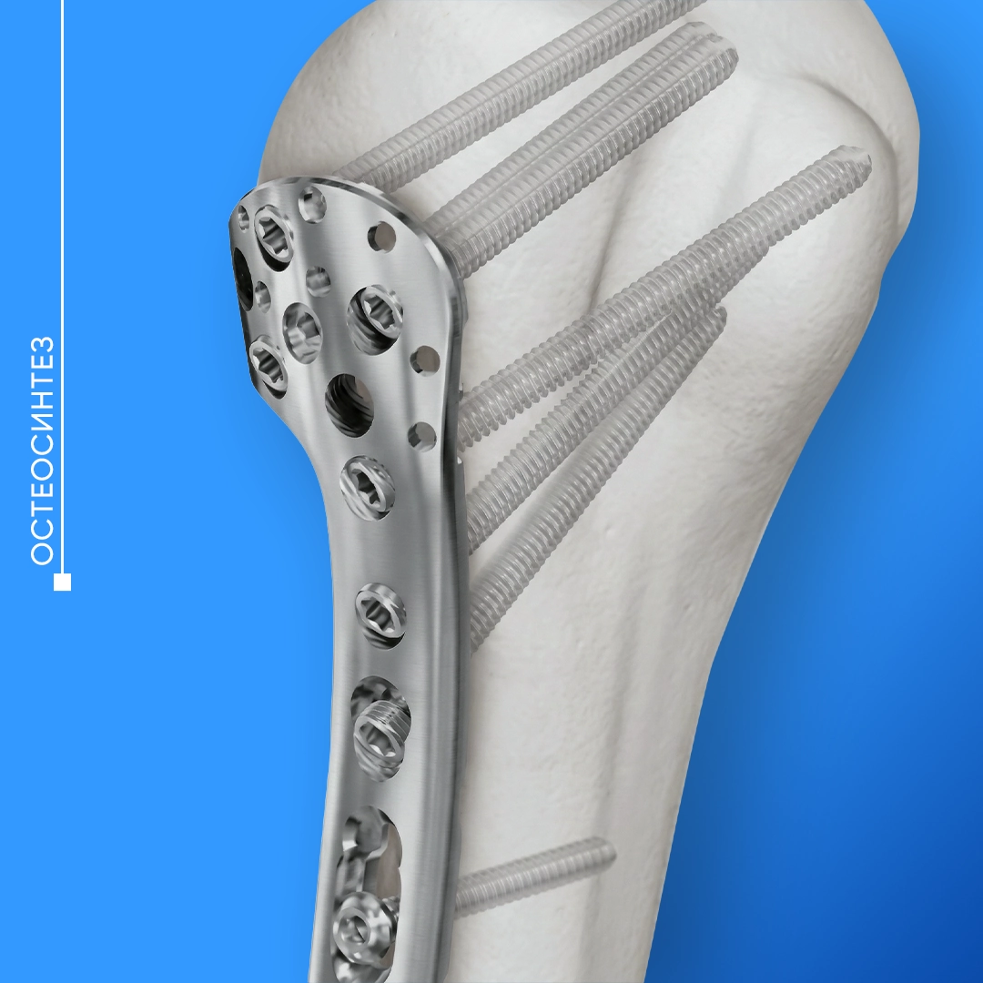 Остеосинтез у Львові для лікування переломів кісток. Фіксація перелому пластиною та гвинтами для стабільного зрощення кістки.