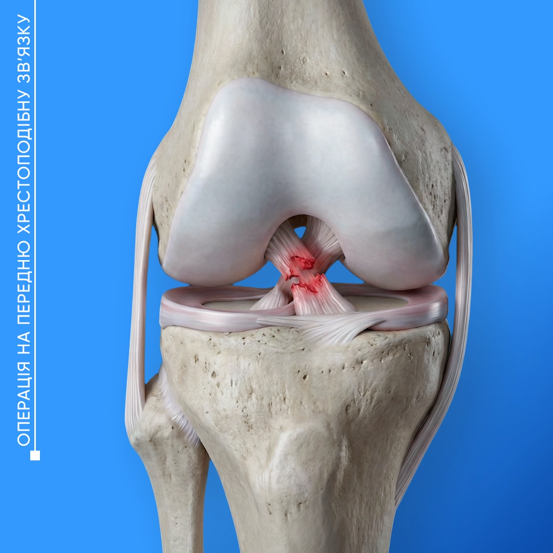 Пластика передньої хрестоподібної зв’язки у Львові. Операція для відновлення стабільності колінного суглоба після розриву ПХЗ.