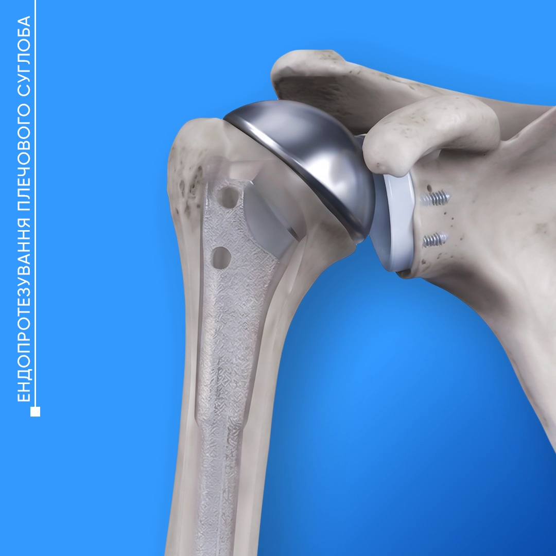 Встановленого штучного плечового імпланта в плечовій кістці під час ортопедичної операції