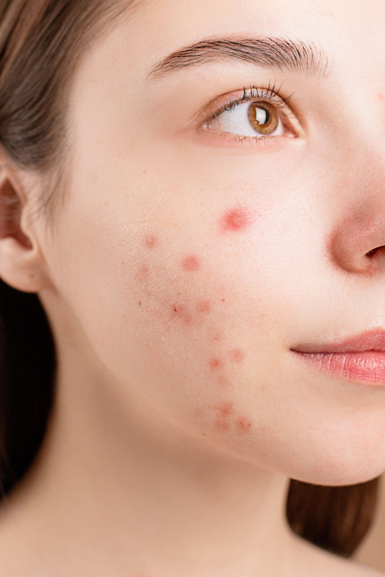 Why Isn't Tretinoin Clearing My Breakouts? It Might Be Fungal Acne, Not Bacterial