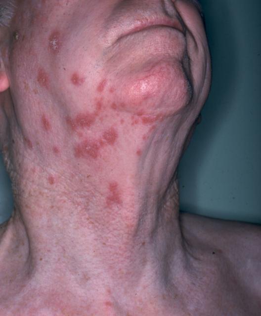 Shingles Treatment Online