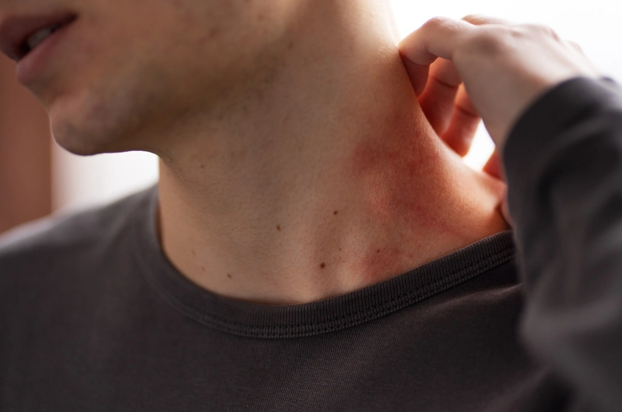 Keto Diet Rash