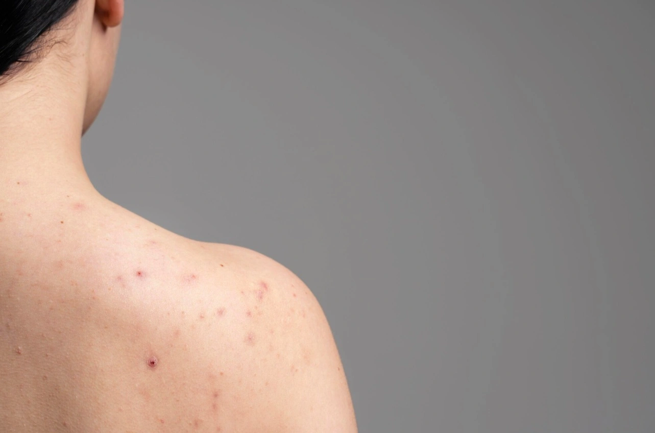 Keto Diet Rash