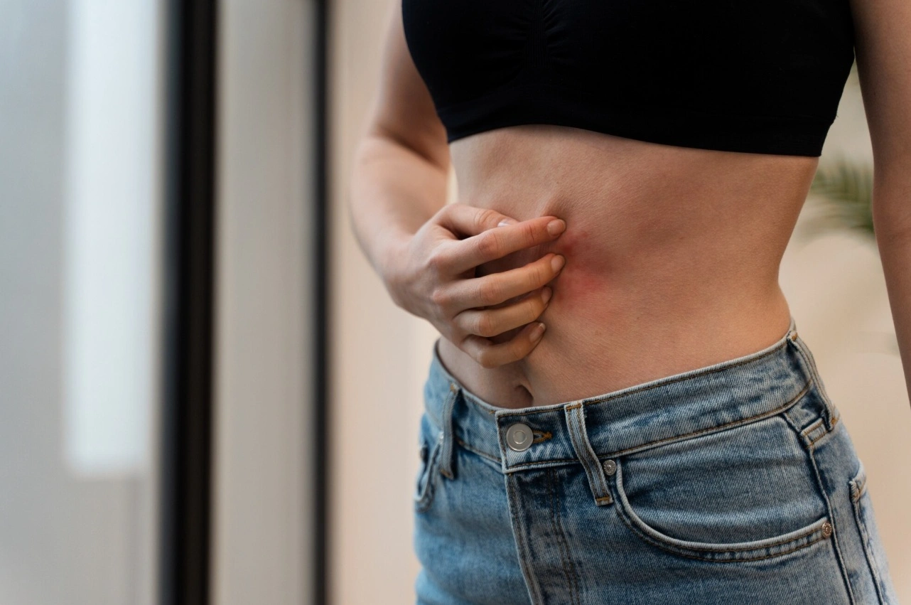 Keto Diet Rash