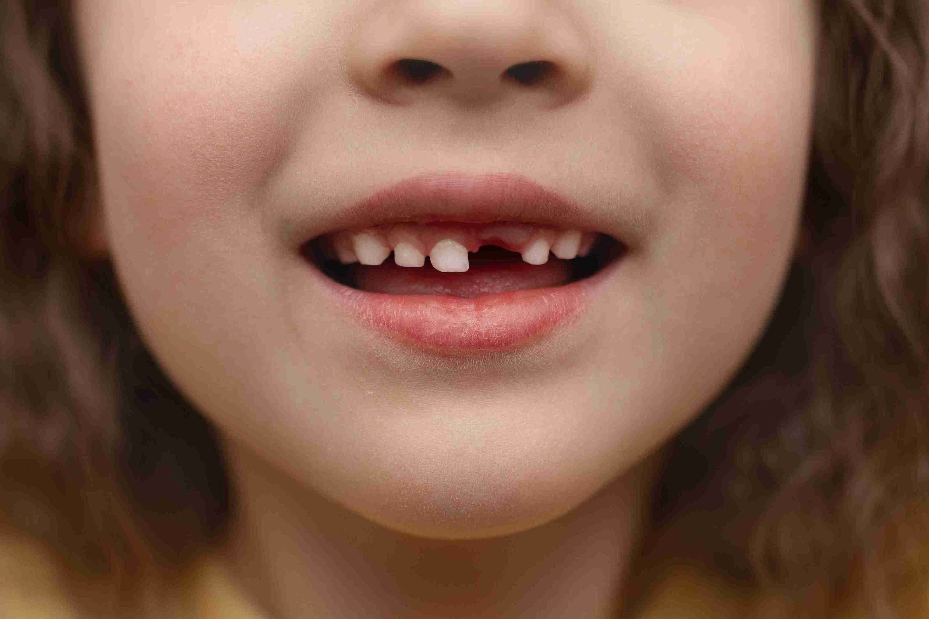 Child smiling with a missing front tooth relevant to missing tooth clause Image Description: Close-up of a child’s smile showing a missing front tooth, illustrating tooth loss considerations under the missing tooth clause.