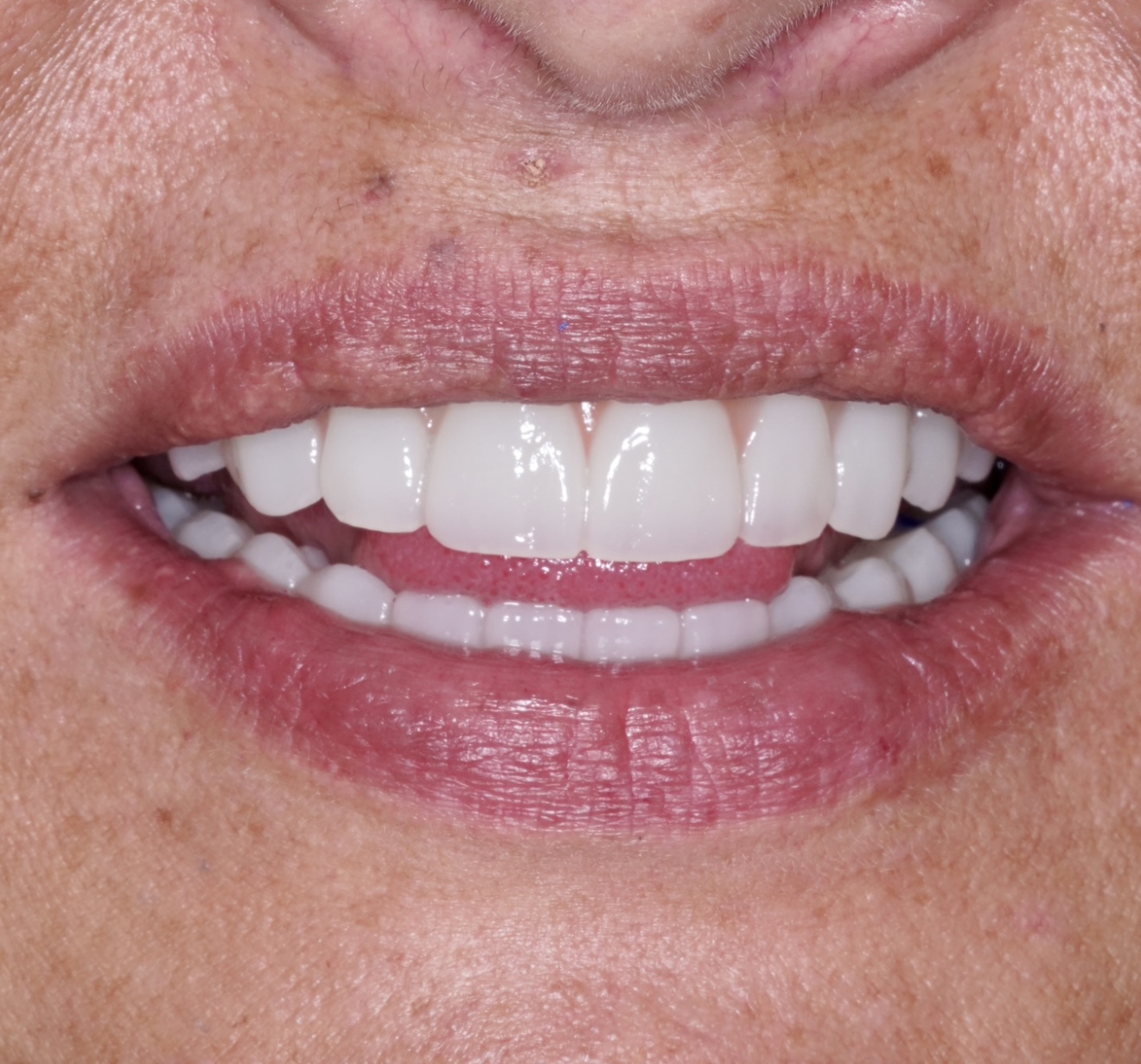 Full Mouth Dental Implants Yarris Family Dental