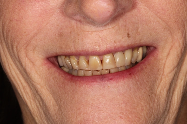 Close-up of a smiling person's mouth showing discolored and stained upper and lower teeth.