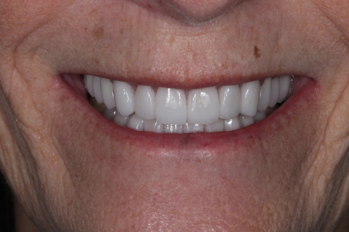Close-up of a smiling mouth with clean, evenly shaped white dental crowns on upper teeth.