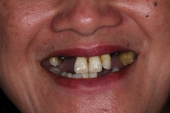 Close-up of a person's mouth showing missing and discolored teeth with visible dental decay.