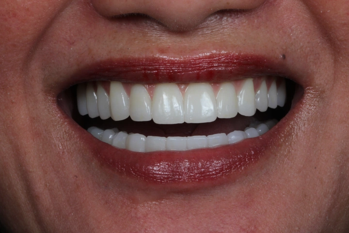 Close-up of a smiling mouth with straight, white teeth and lips with dark red lipstick.