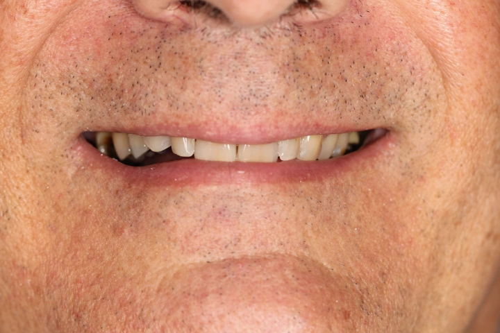 Close-up of a man's mouth showing slightly crooked and uneven teeth with some discoloration.